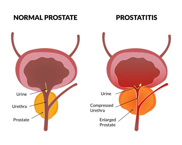 difference betwen normal prostate and prostatis